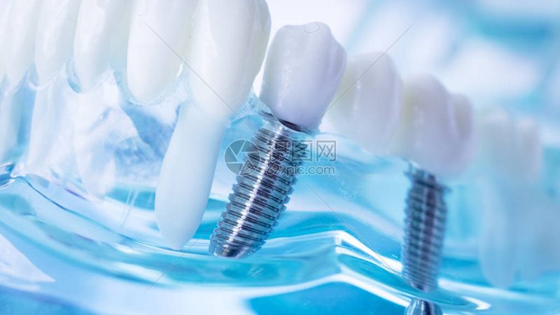 正畸保持器价格之谜：揭秘影响价格的关键因素**